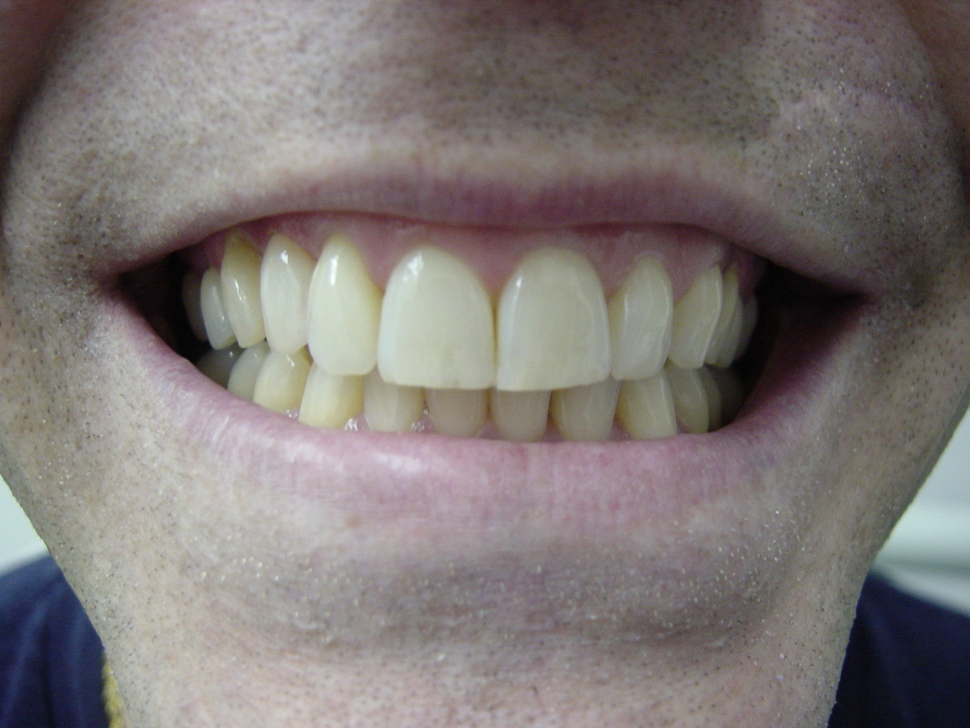 Patient smile after cosmetic dentistry treatment at Jeff Rosenthal DDS — case 01