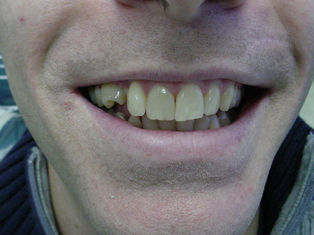 Patient smile before cosmetic dentistry treatment at Jeff Rosenthal DDS — case 01