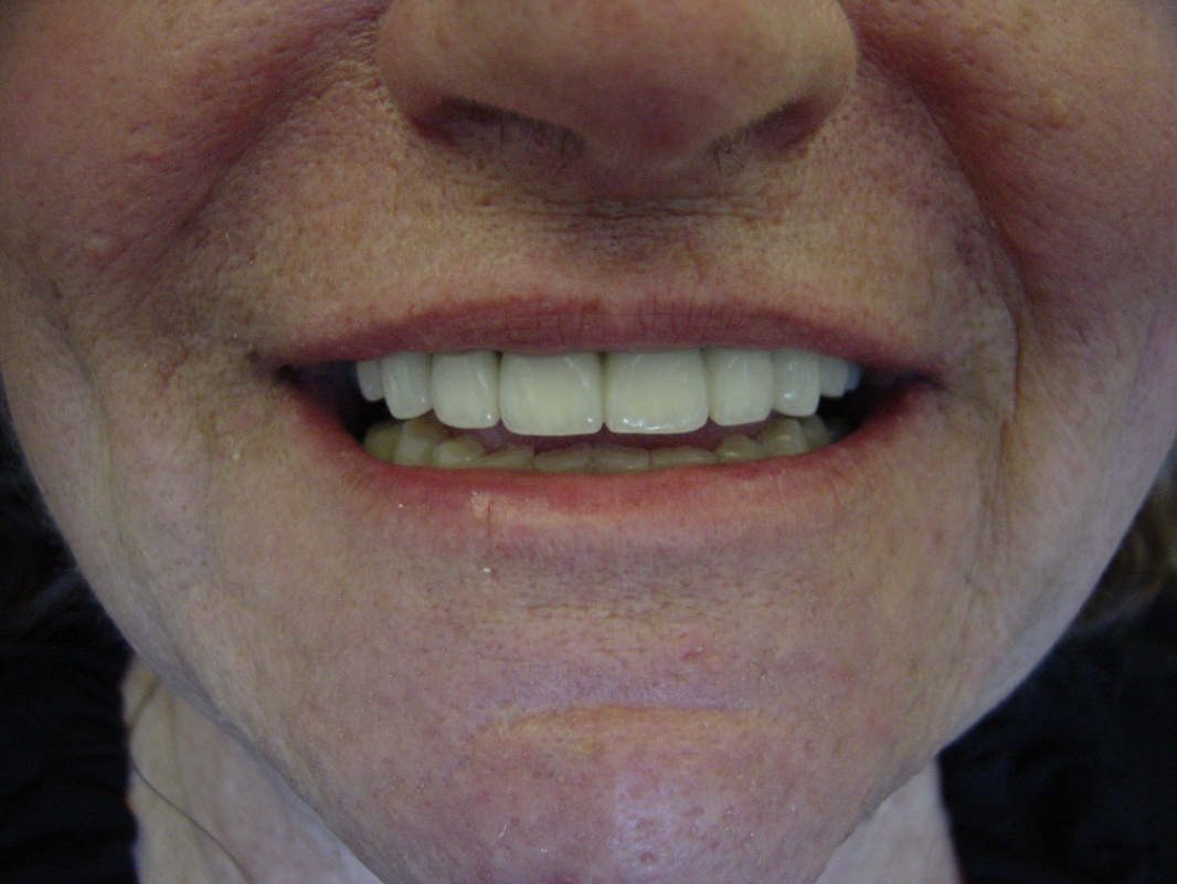 Patient smile after cosmetic dentistry treatment at Jeff Rosenthal DDS — case 02