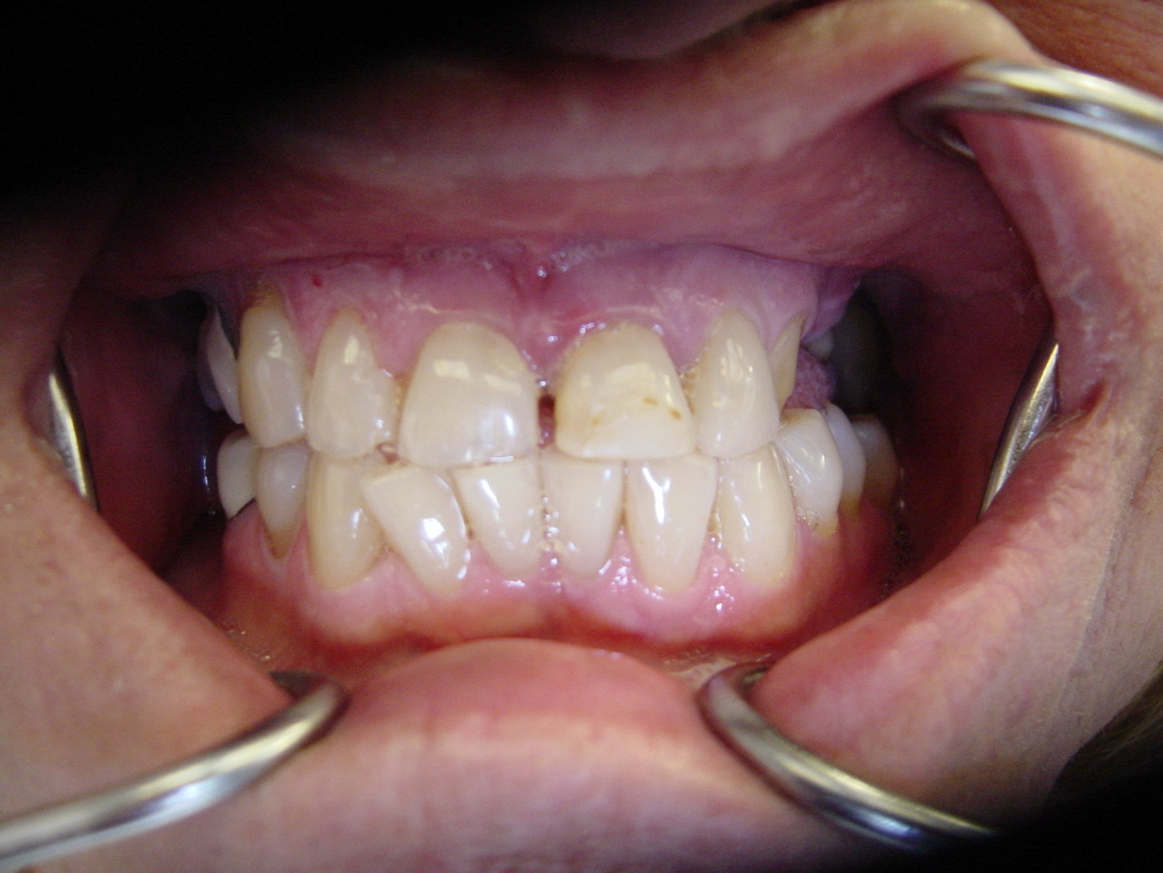 Patient smile before cosmetic dentistry treatment at Jeff Rosenthal DDS — case 02
