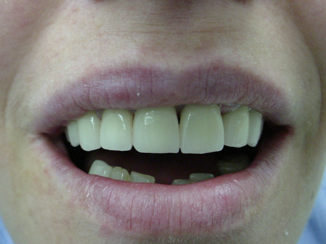 Patient smile after cosmetic dentistry treatment at Jeff Rosenthal DDS — case 05