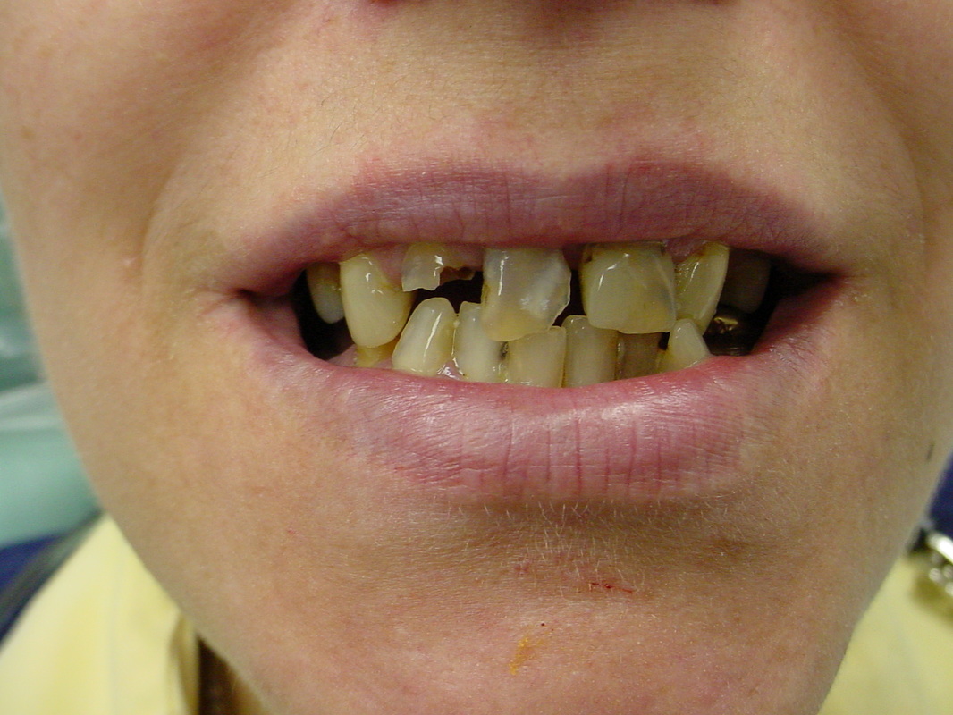 Patient smile before cosmetic dentistry treatment at Jeff Rosenthal DDS — case 05