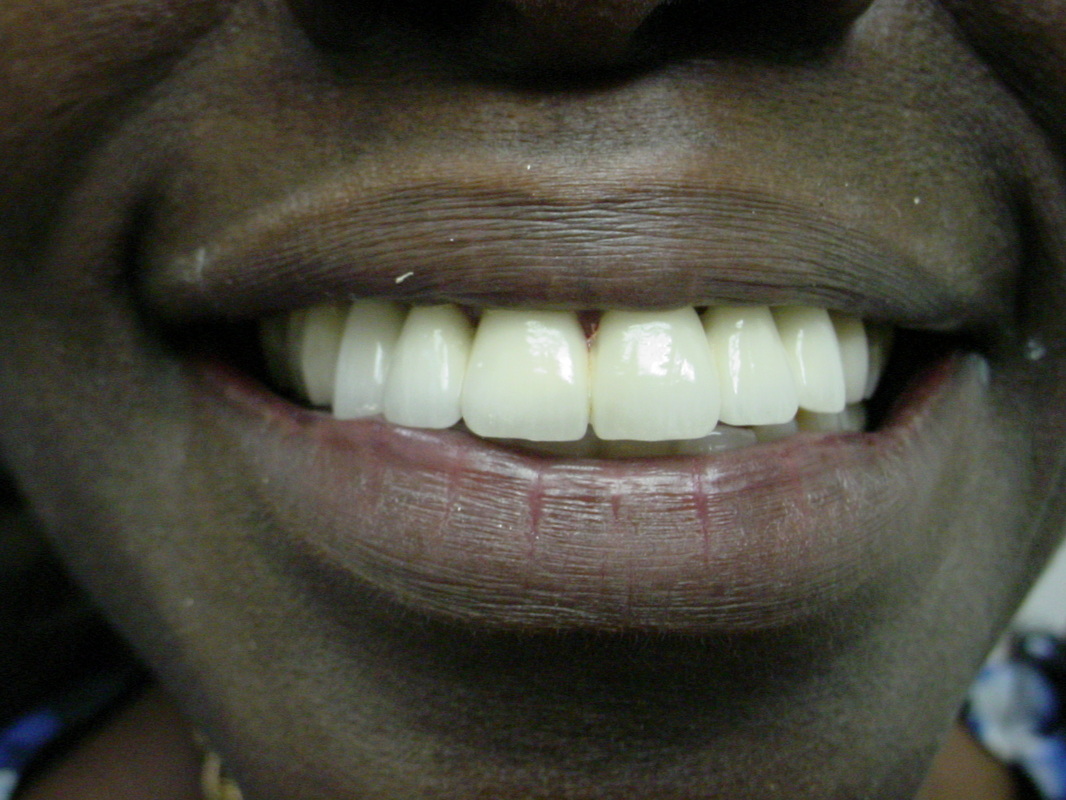 Patient smile after cosmetic dentistry treatment at Jeff Rosenthal DDS — case 06