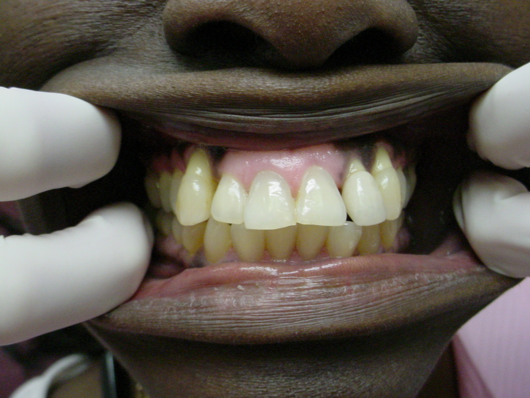 Patient smile before cosmetic dentistry treatment at Jeff Rosenthal DDS — case 06