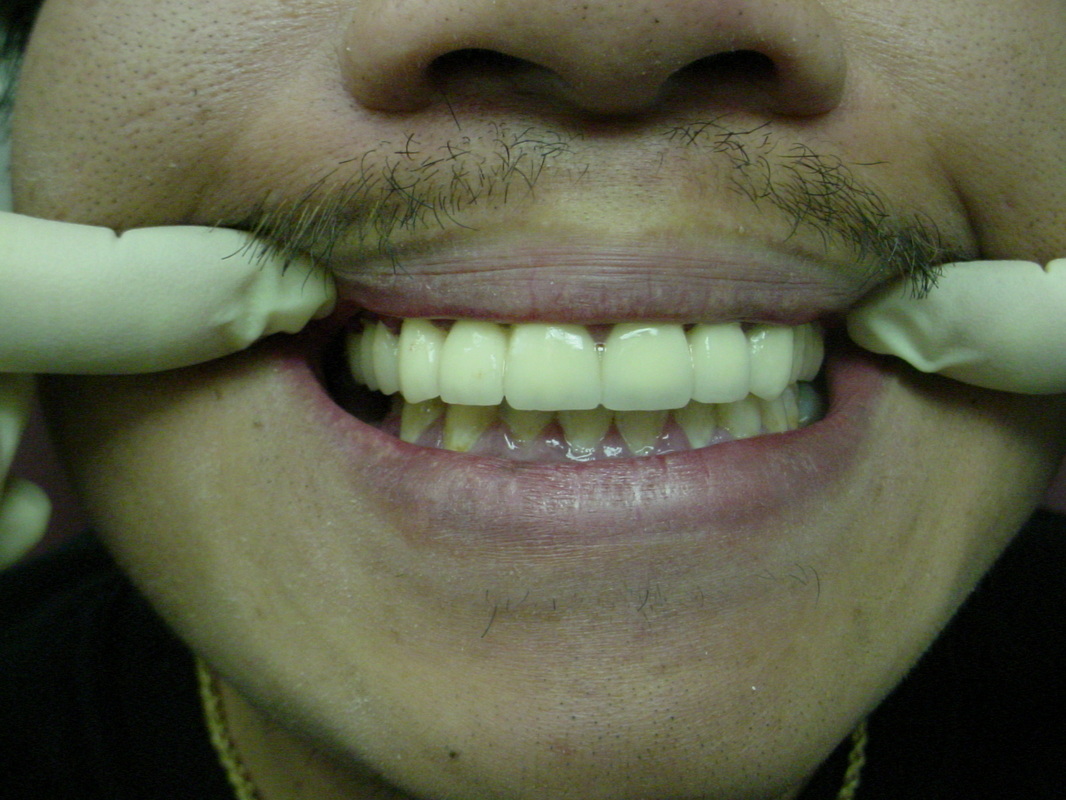 Patient smile after cosmetic dentistry treatment at Jeff Rosenthal DDS — case 07