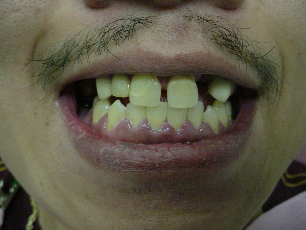 Patient smile before cosmetic dentistry treatment at Jeff Rosenthal DDS — case 07