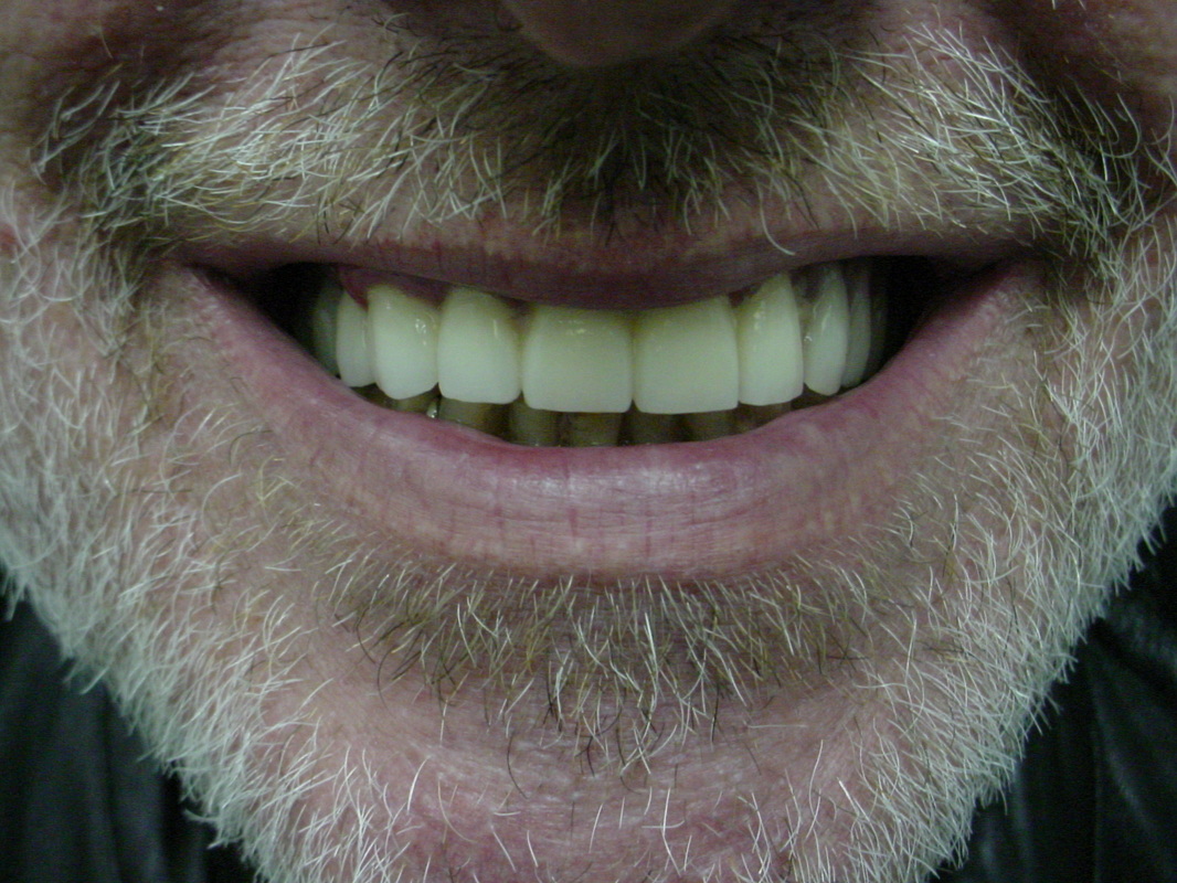 Patient smile after cosmetic dentistry treatment at Jeff Rosenthal DDS — case 08