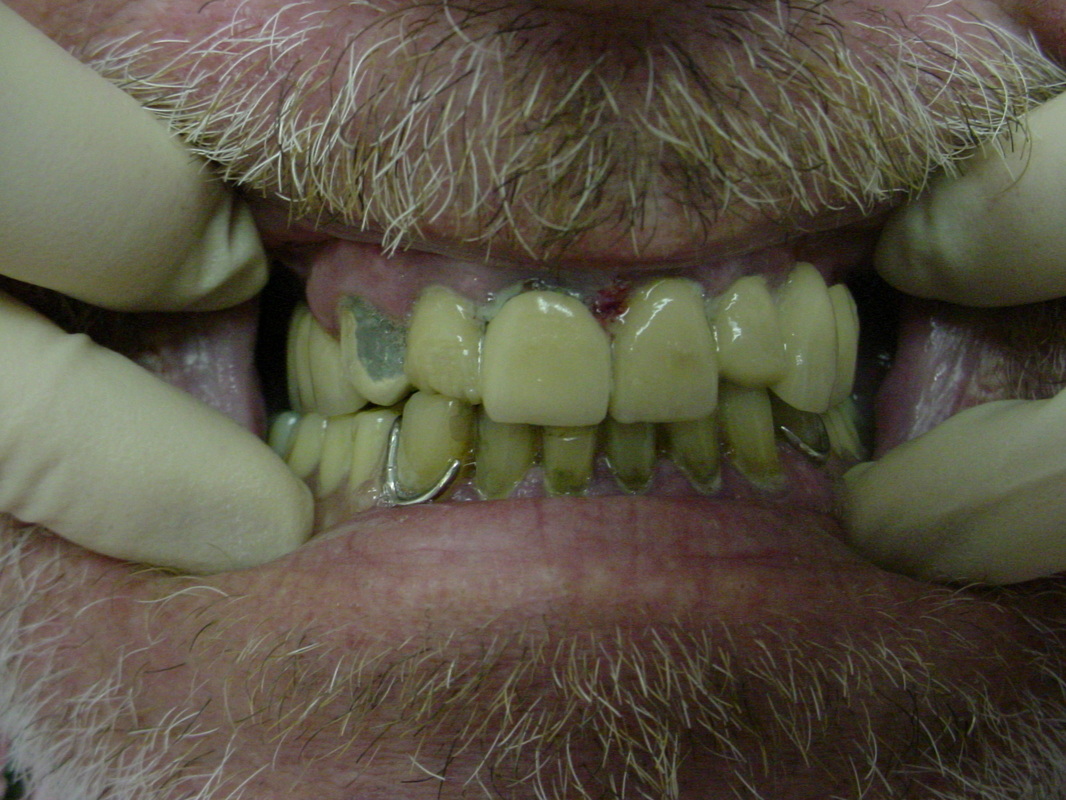 Patient smile before cosmetic dentistry treatment at Jeff Rosenthal DDS — case 08