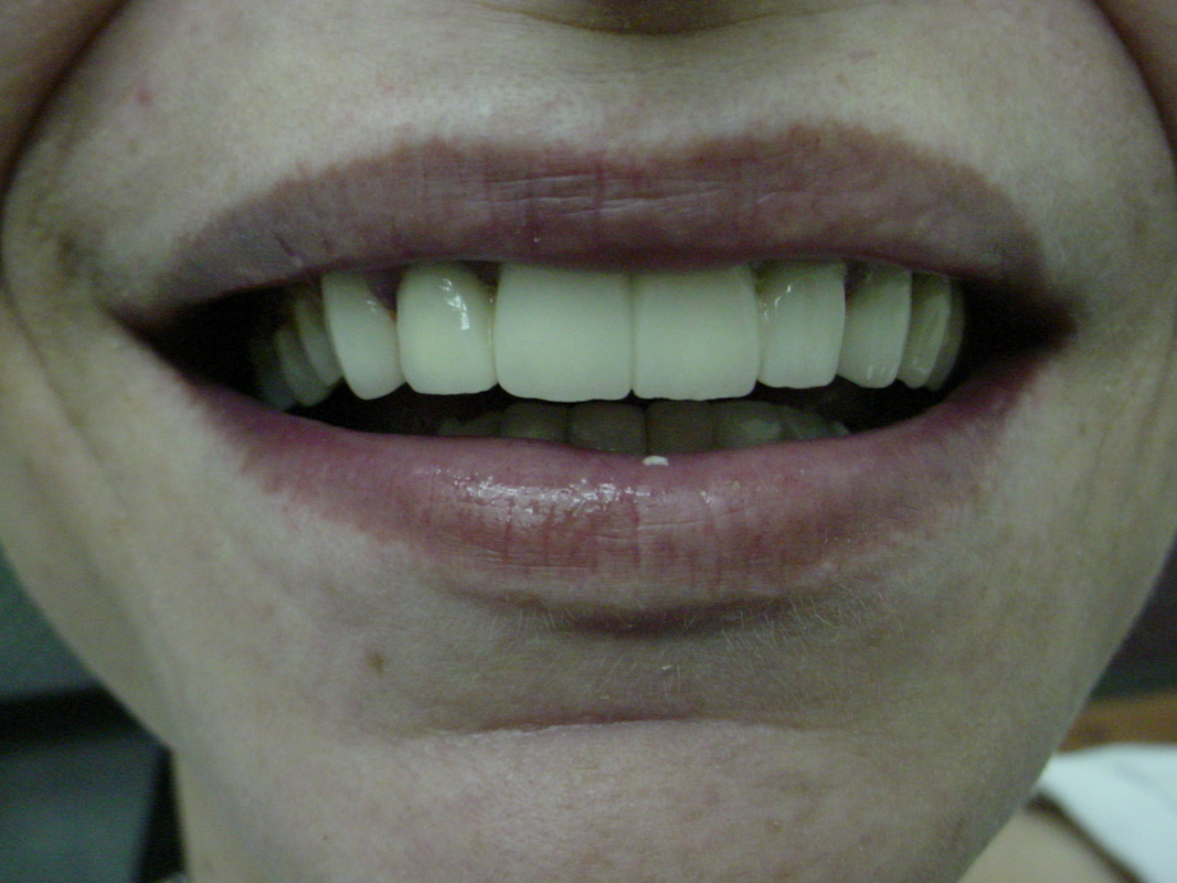 Patient smile after cosmetic dentistry treatment at Jeff Rosenthal DDS — case 09