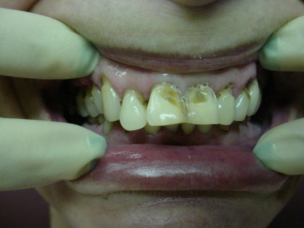 Patient smile before cosmetic dentistry treatment at Jeff Rosenthal DDS — case 09