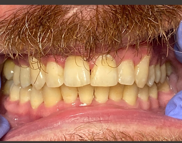 Patient smile after cosmetic dentistry treatment at Jeff Rosenthal DDS — case 10