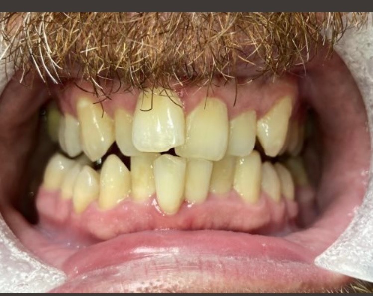 Patient smile before cosmetic dentistry treatment at Jeff Rosenthal DDS — case 10