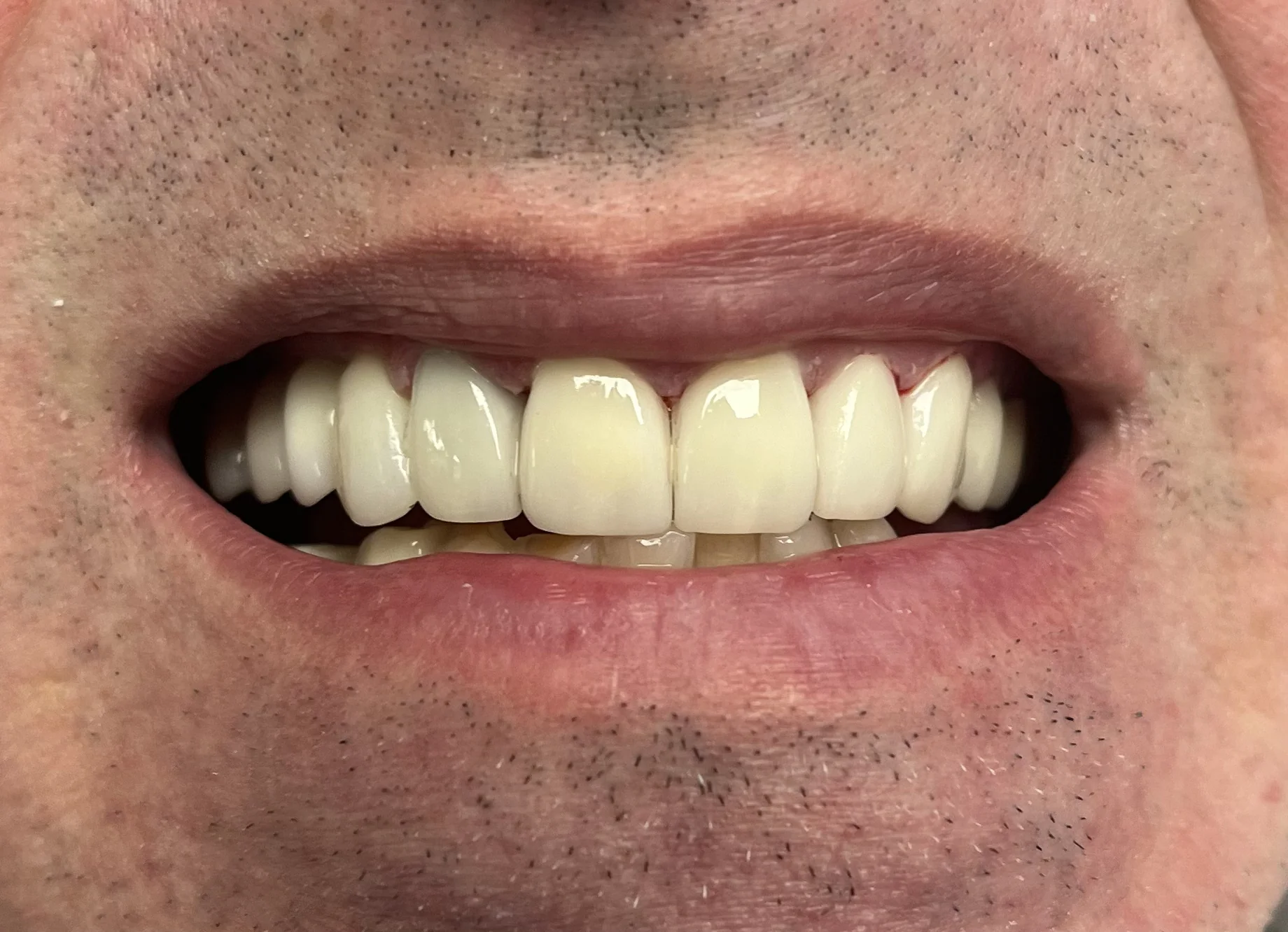 Patient smile after cosmetic dentistry treatment at Jeff Rosenthal DDS — case 11