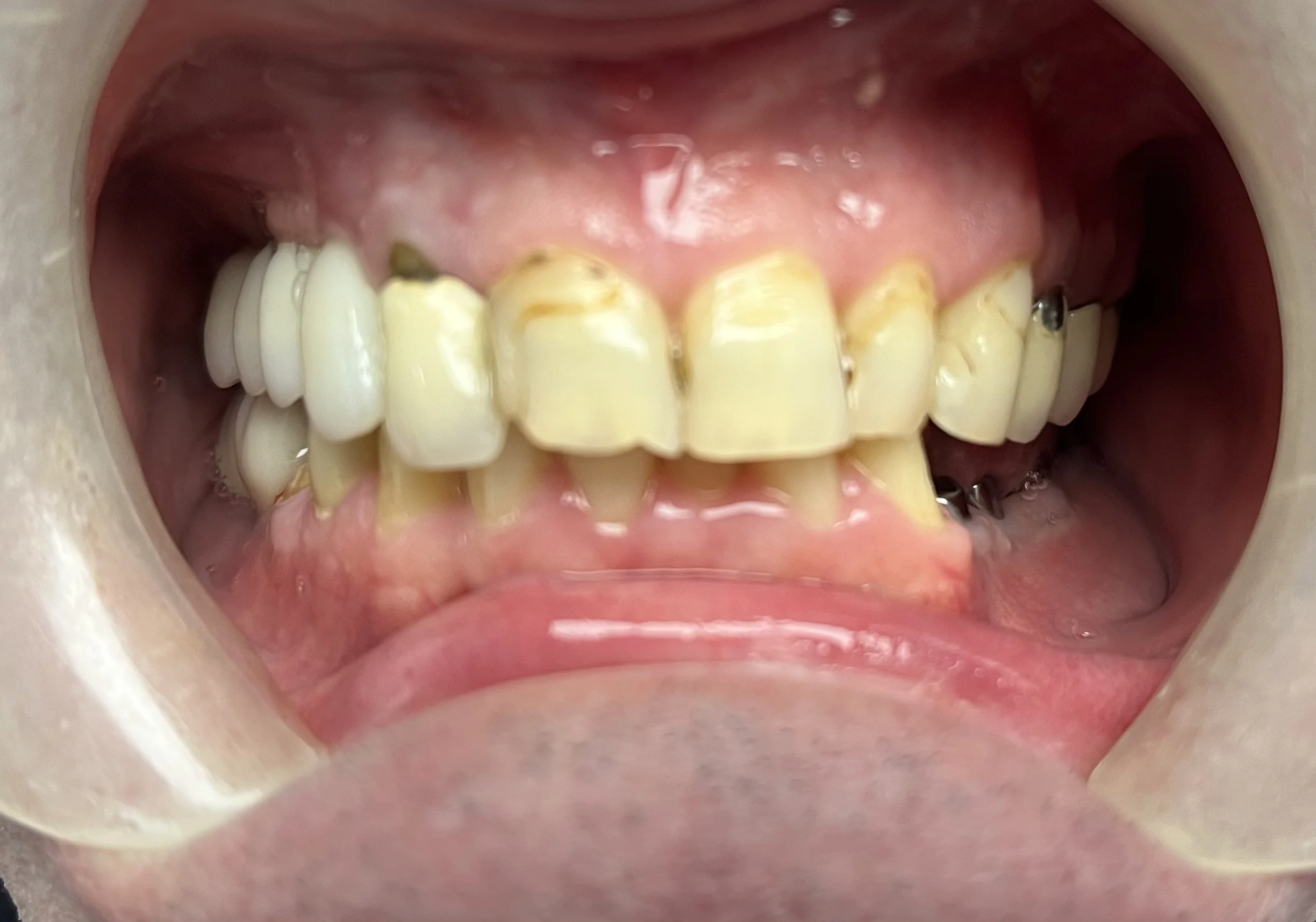Patient smile before cosmetic dentistry treatment at Jeff Rosenthal DDS — case 11